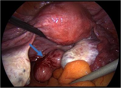 Case report Iatrogenic parasitic leiomyoma: the surgeon's invisible hand